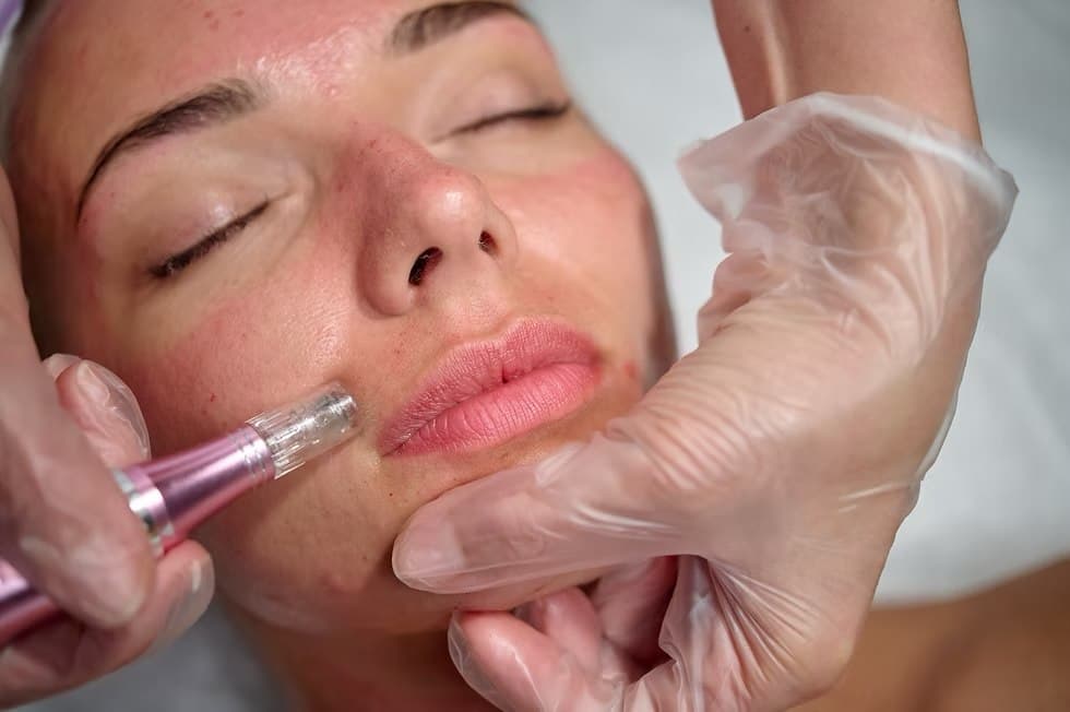 Royal Rose Beauty PRP Facial (Platelet-Rich Plasma) service